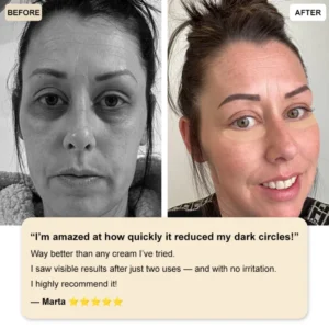 ✅Official Store: Zvoevo® Deep Precision Age-Defying Nano Microneedle Patches – Deep-acting solution for tackling under-eye bags, dark circles, laughter lines, forehead lines, and all those other pesky facial wrinkles.