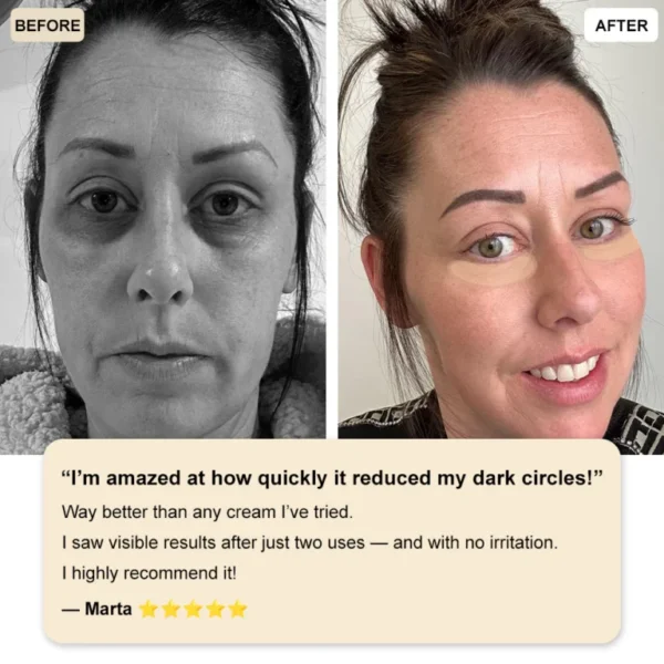 ✅Official Store: Zvoevo® Deep Precision Age-Defying Nano Microneedle Patches – Deep-acting solution for tackling under-eye bags, dark circles, laughter lines, forehead lines, and all those other pesky facial wrinkles.