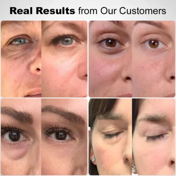 ✅Official Store: Zvoevo® Deep Precision Age-Defying Nano Microneedle Patches – Deep-acting solution for tackling under-eye bags, dark circles, laughter lines, forehead lines, and all those other pesky facial wrinkles.
