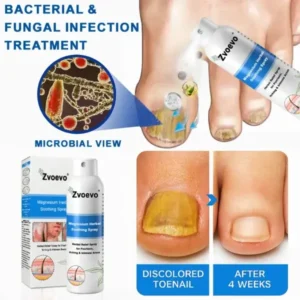 ✅Official Store: Zvoevo®Magnesium Herbal Spray⚕️FDA certified (Relief for Psoriasis and Eczema, Improvement of Bacterial Infections in the Genital Area, and Treatment of Acne and Dark Spots)