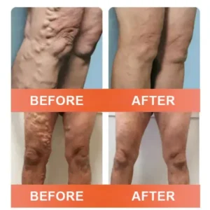 🎁💐Zvoevo® Vein Ease Microneedle Care Patch(For Spider Veins, Varicose Veins, Swelling & Leg Fatigue)