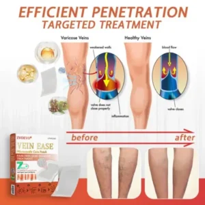 🎁💐Zvoevo® Vein Ease Microneedle Care Patch(For Spider Veins, Varicose Veins, Swelling & Leg Fatigue)