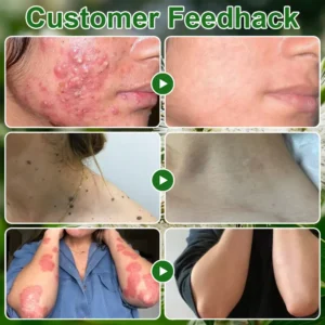 𝐳𝐯𝐨𝐞𝐯𝐨® 𝐓𝐞𝐚 𝐓𝐫𝐞𝐞 𝐎𝐢𝐥 𝐒𝐤𝐢𝐧 𝐓𝐫𝐞𝐚𝐭𝐦𝐞𝐧𝐭 𝐂𝐫𝐞𝐚𝐦