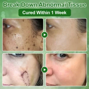 𝐳𝐯𝐨𝐞𝐯𝐨® 𝐓𝐞𝐚 𝐓𝐫𝐞𝐞 𝐎𝐢𝐥 𝐒𝐤𝐢𝐧 𝐓𝐫𝐞𝐚𝐭𝐦𝐞𝐧𝐭 𝐂𝐫𝐞𝐚𝐦