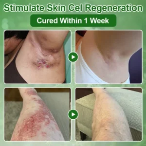 𝐳𝐯𝐨𝐞𝐯𝐨® 𝐓𝐞𝐚 𝐓𝐫𝐞𝐞 𝐎𝐢𝐥 𝐒𝐤𝐢𝐧 𝐓𝐫𝐞𝐚𝐭𝐦𝐞𝐧𝐭 𝐂𝐫𝐞𝐚𝐦